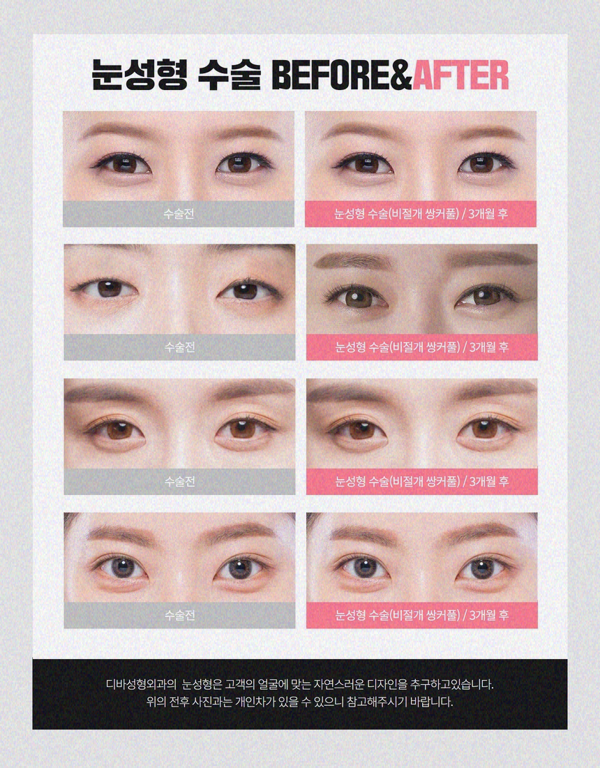 중년쌍꺼풀 노화로 인해 처진다면 관련 이미지 9