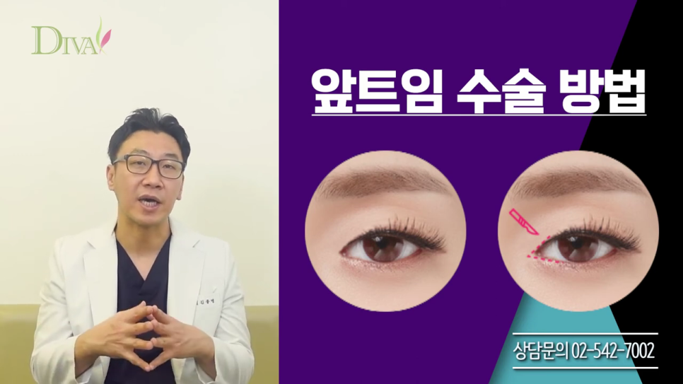 눈매교정술 개개인에 따라 관련 이미지 3