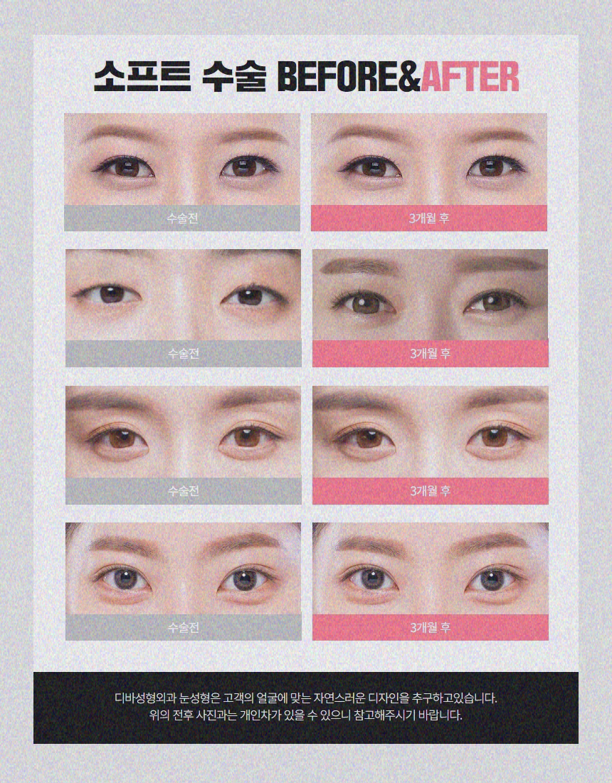 눈밑지방제거 환한 인상을 바라는 경우 관련 이미지 9