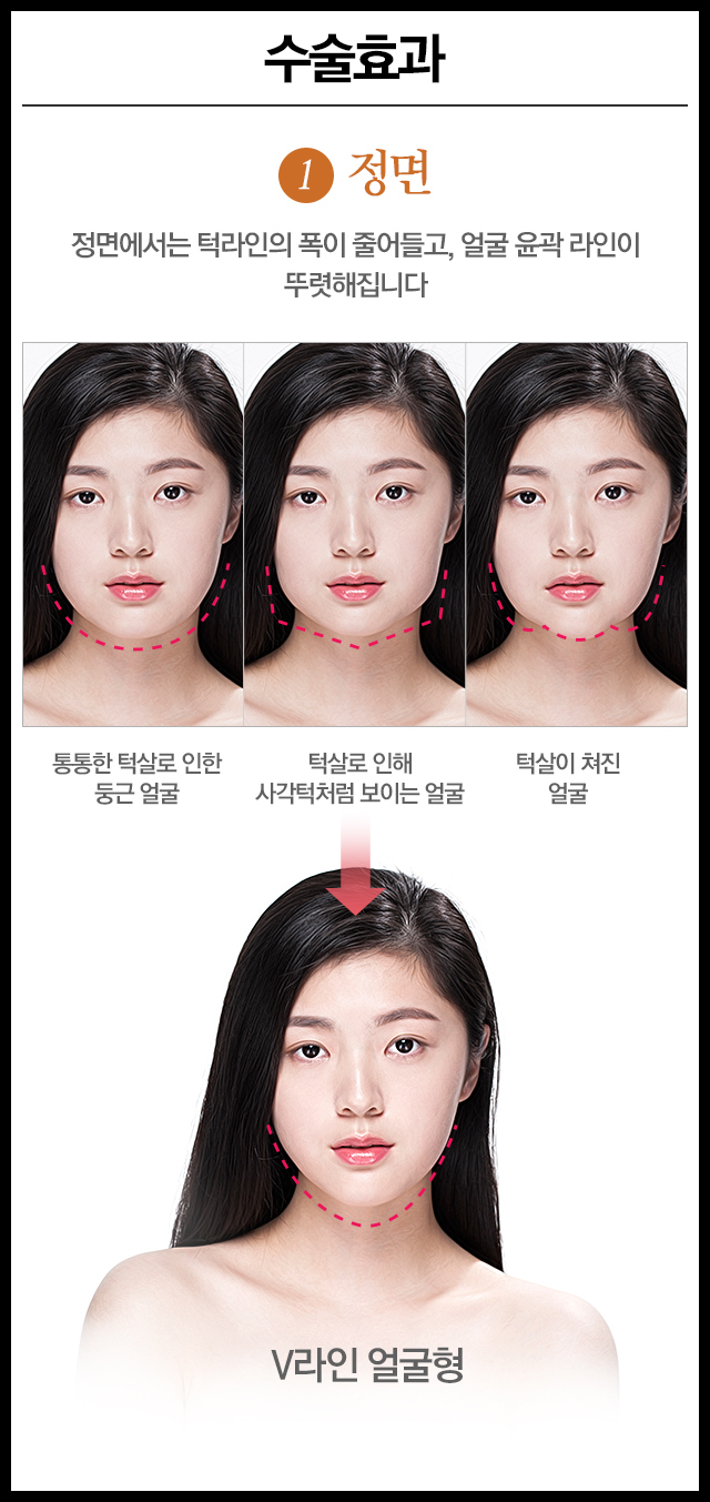 이중턱리프팅 V라인의 완성! 관련 이미지 3
