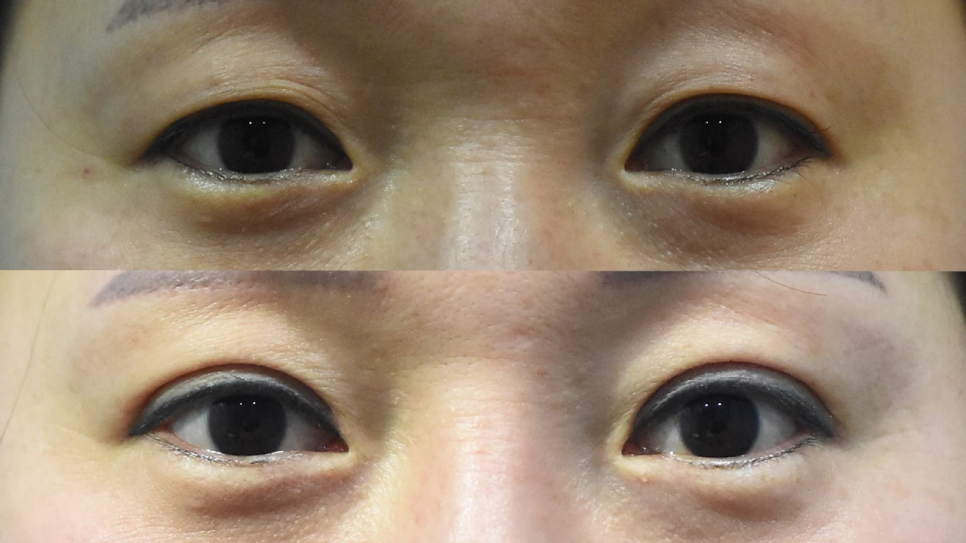 중년쌍꺼풀 노화로 인해 처진다면 관련 이미지 3