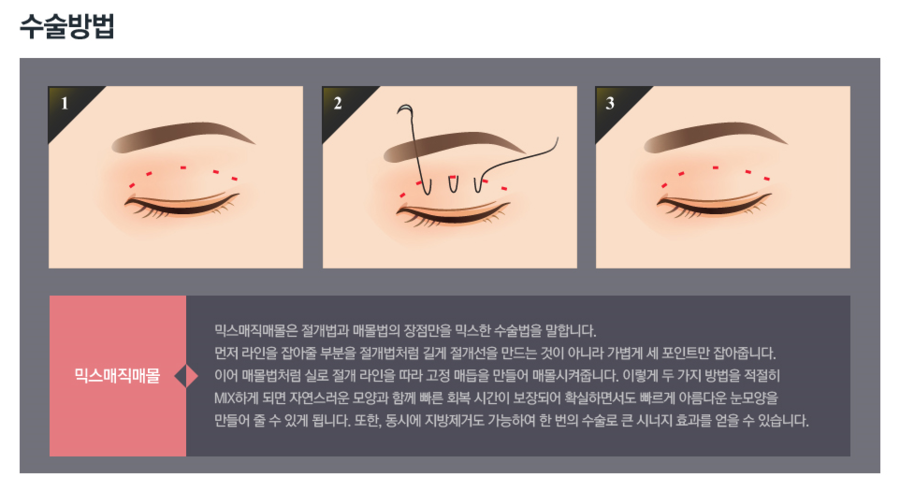 디바성형외과의 눈성형, 믹스매직매몰이란? 관련 이미지 4