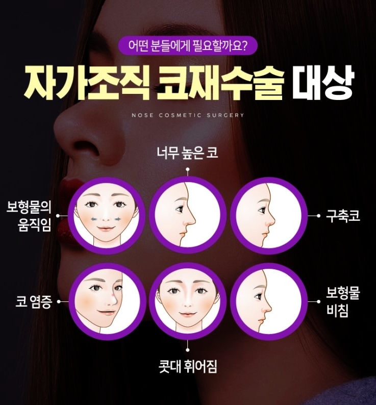 코재수술잘하는곳 찾는 이유는? 관련 이미지 6