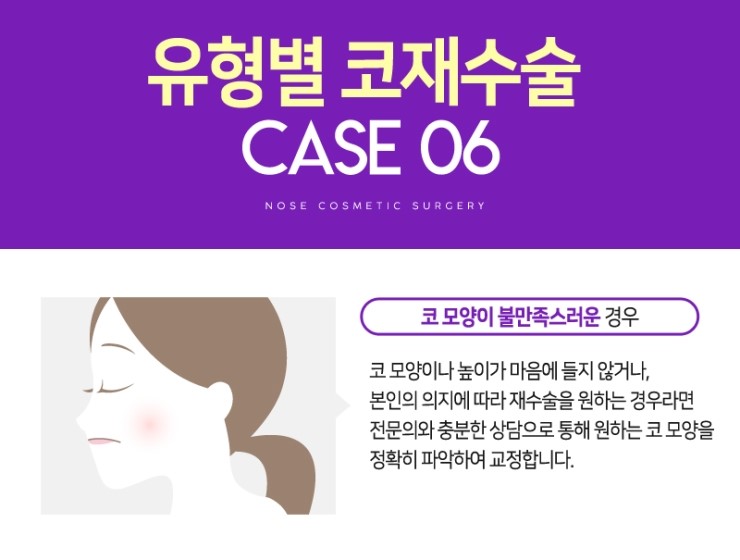 코재수술, 성공하기 위해서 알아야하는 체크사항 관련 이미지 14