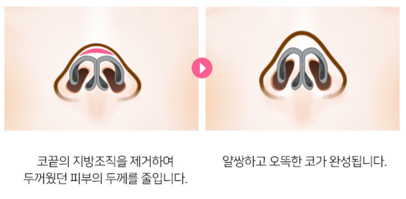 [디바성형외과] 복코코끝성형 세련되고 날렵한 이미지로! 관련 이미지 6