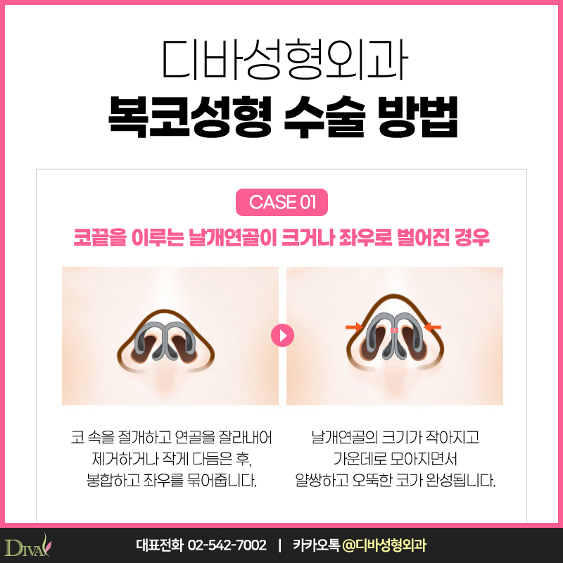 [디바성형외과] 복코성형으로 세련미 넘치게 관련 이미지 3