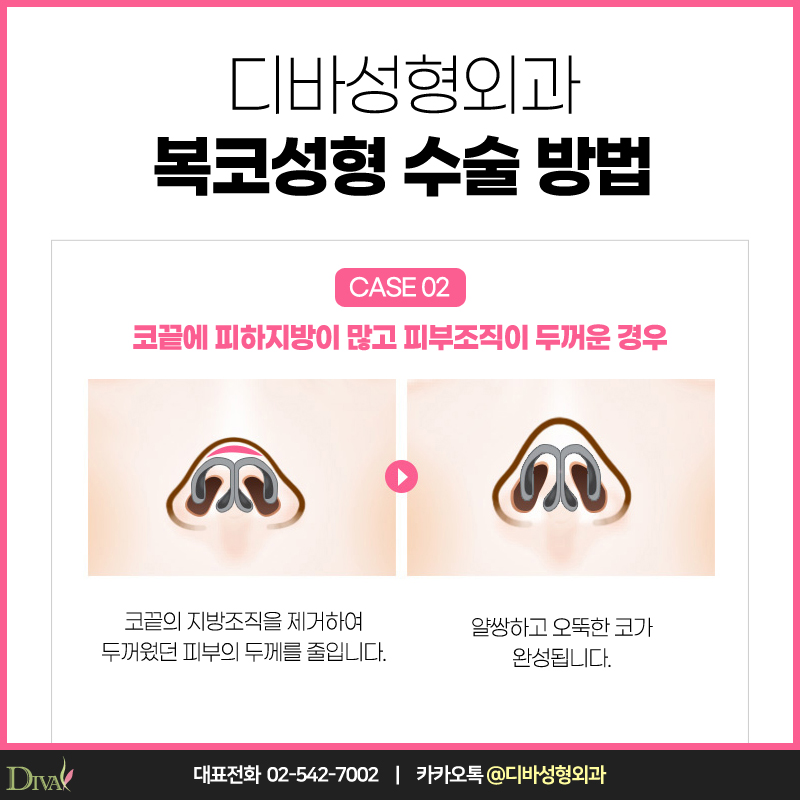 [디바성형외과] 복코성형으로 세련미 넘치게 관련 이미지 4