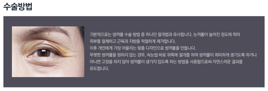 중년눈성형 상안검수술에 대해 알아보자! 관련 이미지 4