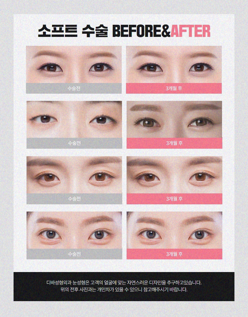 눈매교정붓기 빼는 방법 얼마나 갈까? 관련 이미지 9