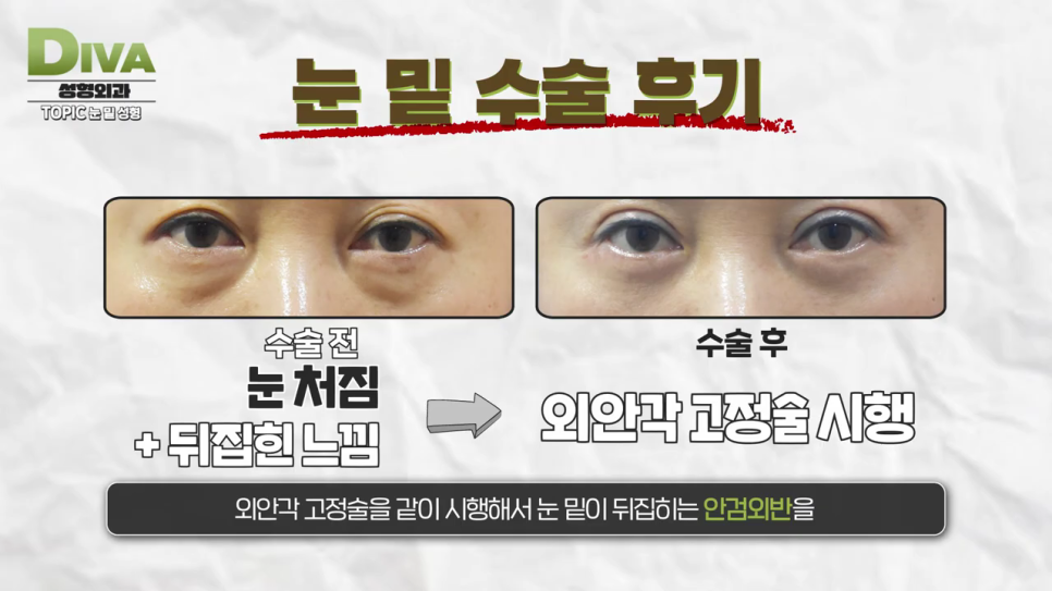 눈밑지방재배치수술 어려보이는 동안외모 완성하기 관련 이미지 7