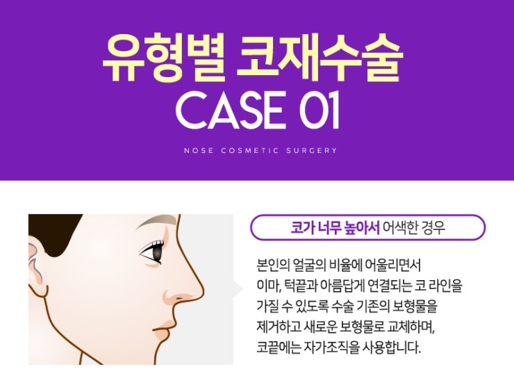 코재수술, 성공하기 위해서 알아야하는 체크사항 관련 이미지 9