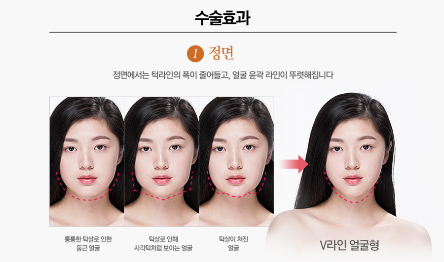 이중턱지방흡입으로 입체적이고 갸름한 얼굴 완성! 관련 이미지 2