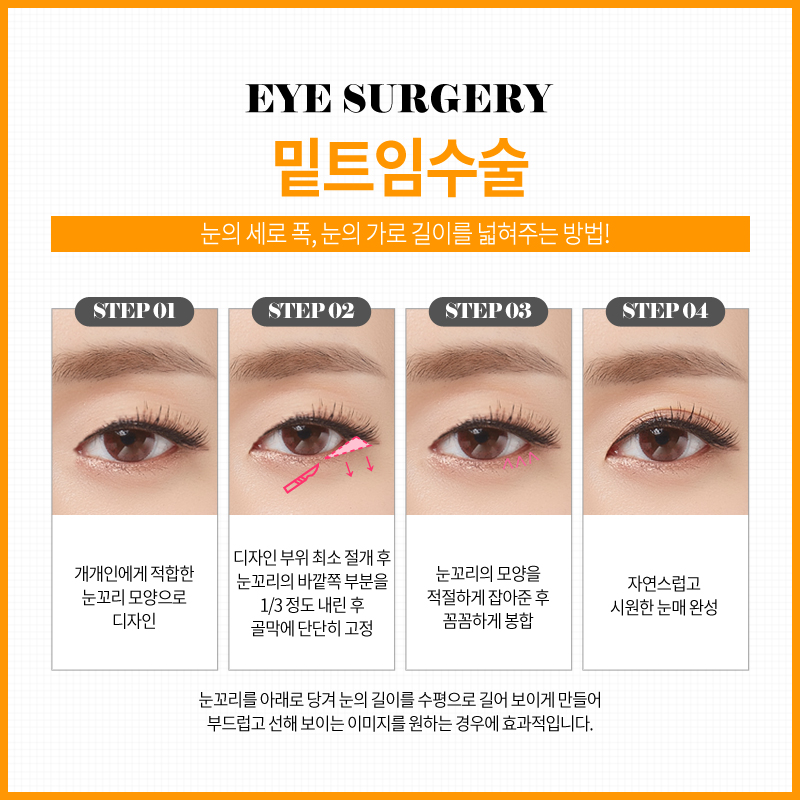 쌍꺼풀수술? 트임수술? 나에게 맞는 눈성형은? 관련 이미지 17