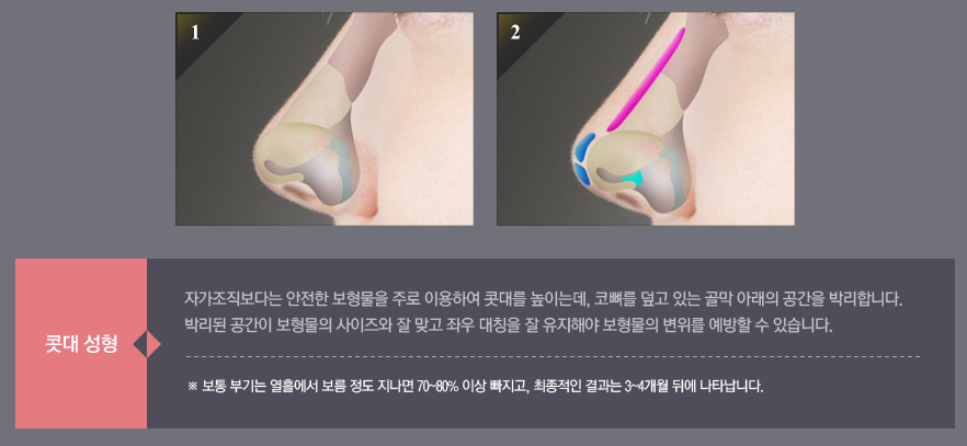 콧대성형 디바성형외과에서 예쁜 콧대 완성! 관련 이미지 4