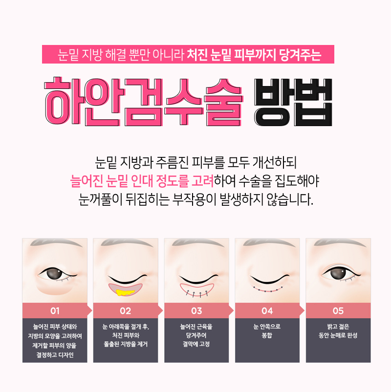 하안검수술 회복기간 얼마나 걸릴까? 관련 이미지 8