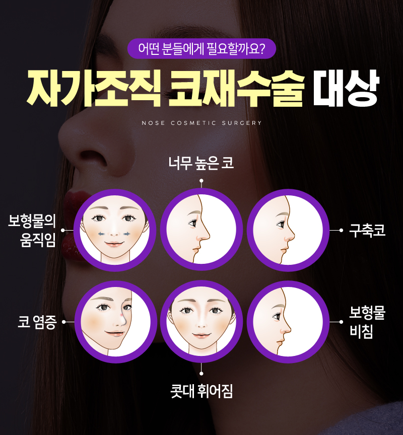 [디바성형외과] 실패한 매부리코 성형 재수술, 효과와 만족도 높이려면 관련 이미지 2