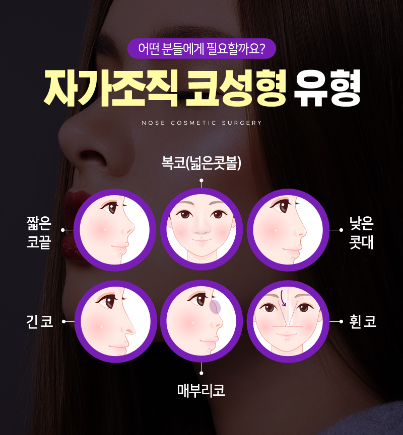 나에게 필요한 코성형 수술 방법 관련 이미지 8