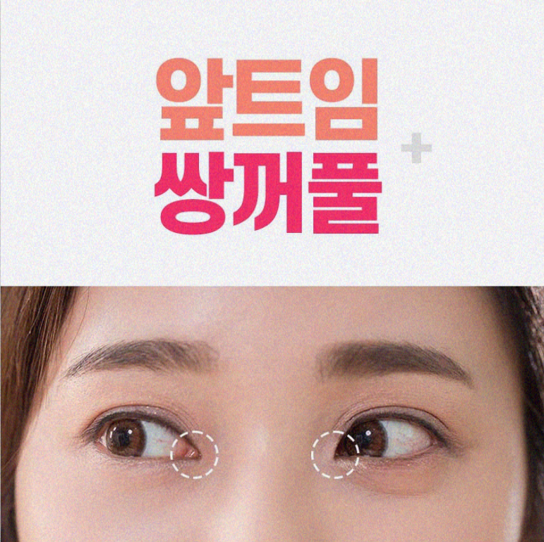 안검하수수술 눈매에 고민이 있다면 관련 이미지 10