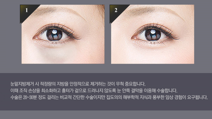 눈밑지방제거수술 깨끗한 눈매, 생기있는 눈 완성! 관련 이미지 3