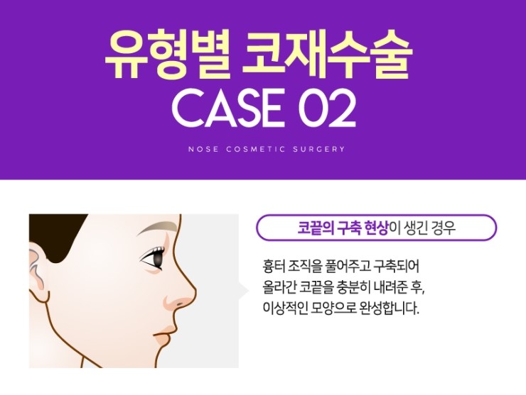 코재수술, 성공하기 위해서 알아야하는 체크사항 관련 이미지 10
