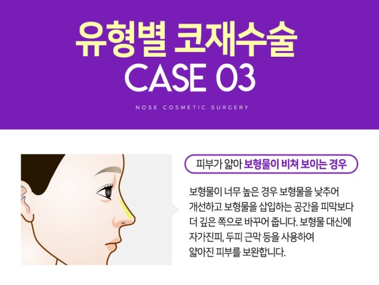 코재수술, 성공하기 위해서 알아야하는 체크사항 관련 이미지 11