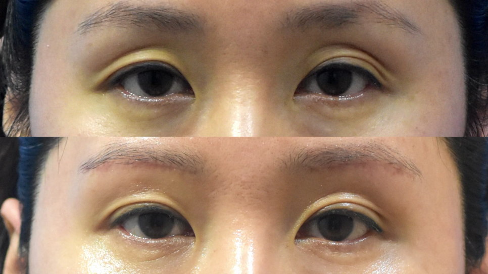 중년눈성형 깔끔한 확인으로 관련 이미지 5