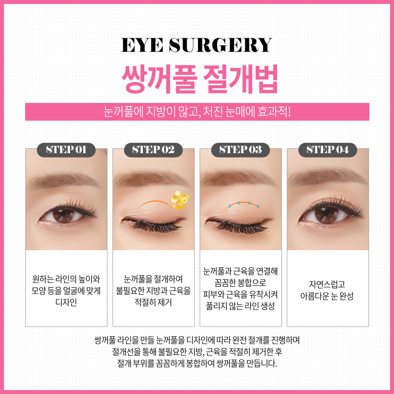 쌍꺼풀수술? 트임수술? 나에게 맞는 눈성형은? 관련 이미지 8