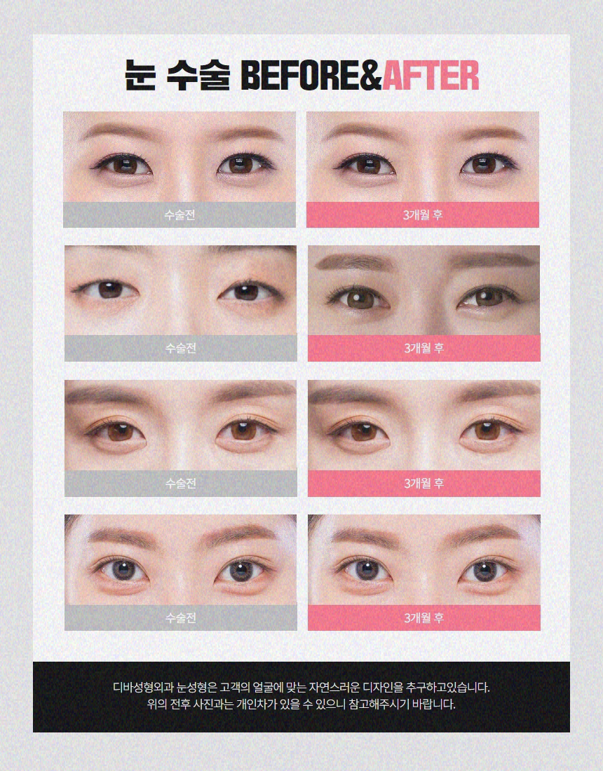 중년눈매교정 또렷함을 바란다면 관련 이미지 10