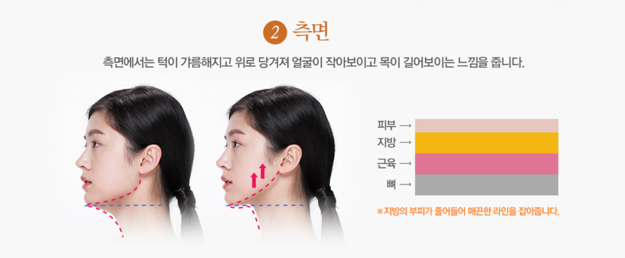 이중턱지방흡입으로 입체적이고 갸름한 얼굴 완성! 관련 이미지 3