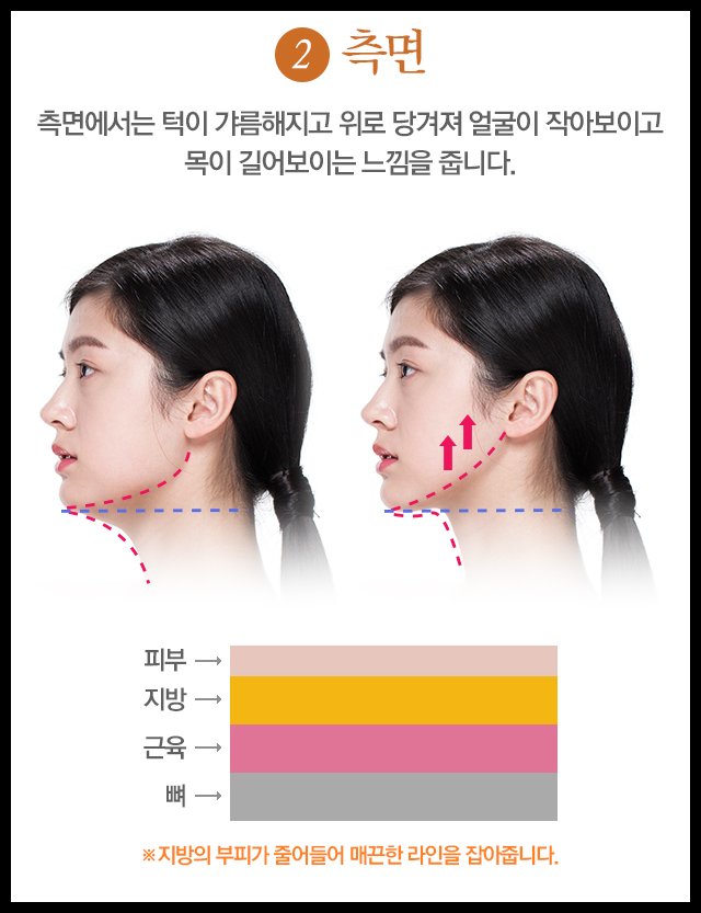 이중턱리프팅 V라인의 완성! 관련 이미지 4