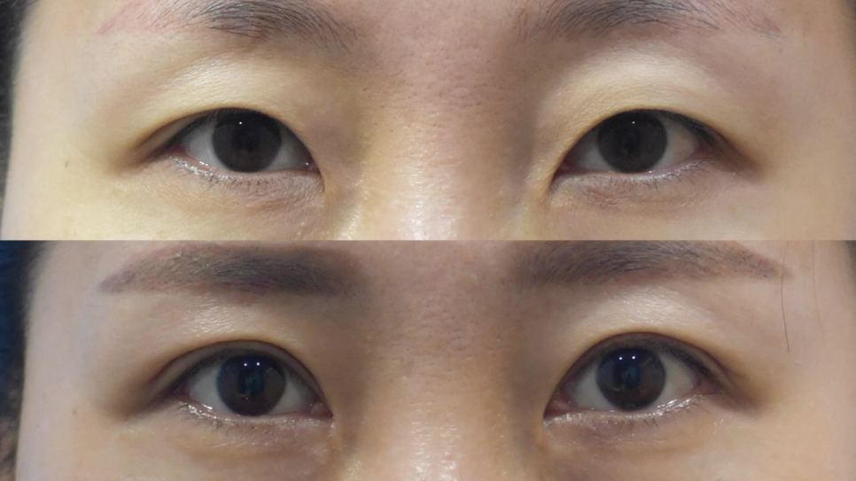 중년쌍수 눈매를 또렷하게 만드는 상안검수술 관련 이미지 5