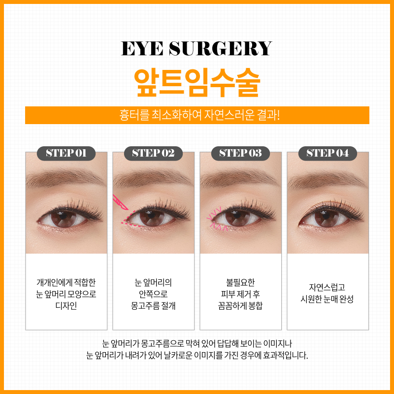 쌍꺼풀수술? 트임수술? 나에게 맞는 눈성형은? 관련 이미지 14