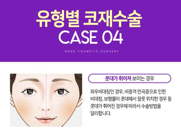코재수술, 성공하기 위해서 알아야하는 체크사항 관련 이미지 12