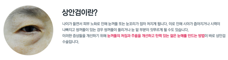 중년눈성형 상안검수술에 대해 알아보자! 관련 이미지 2