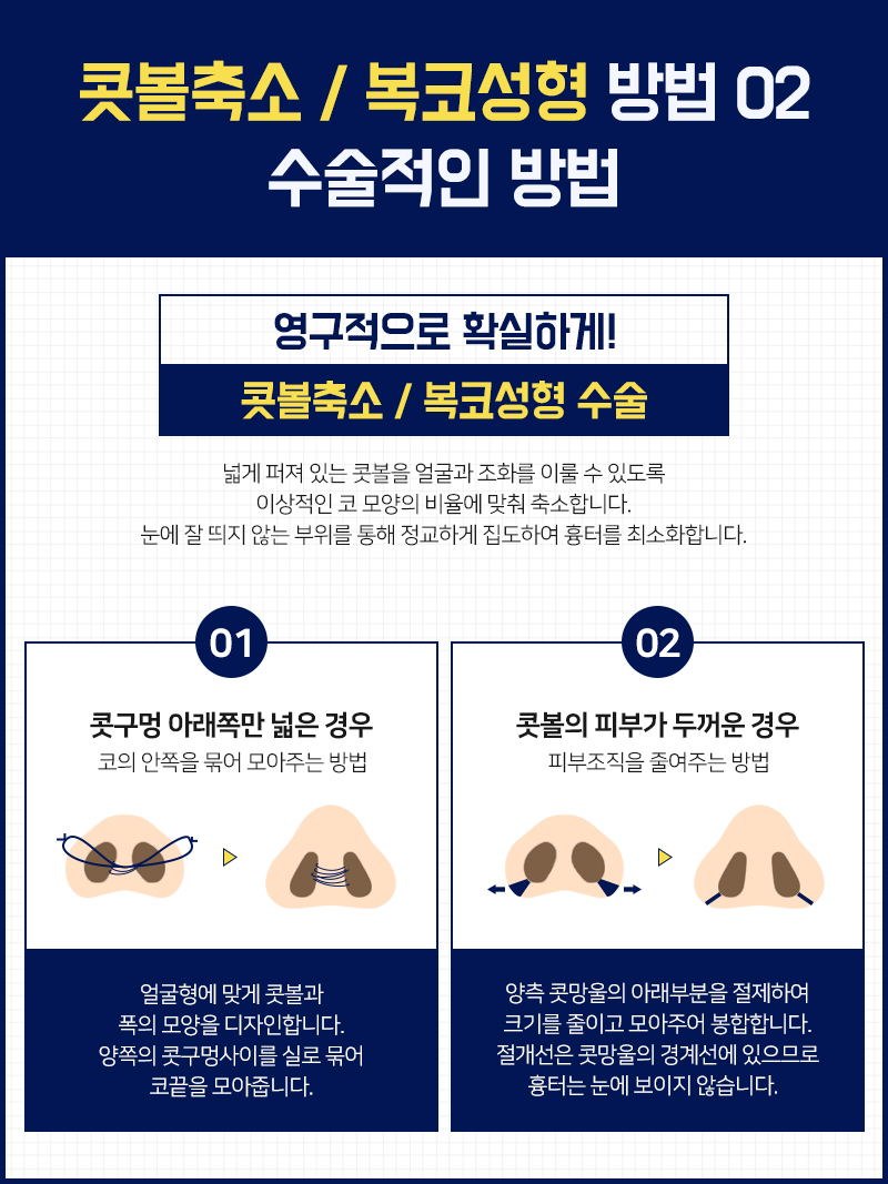 코성형 능력자가 말하는 복코 & 콧볼축소 방법은? 관련 이미지 8