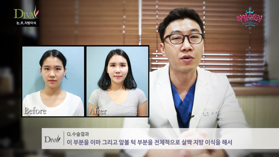 비절개눈매교정 자연스러운 라인으로 관련 이미지 4