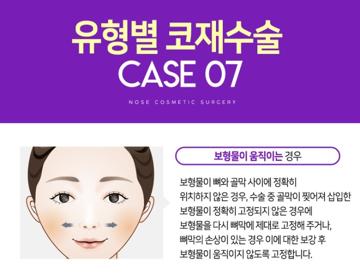 코재수술, 성공하기 위해서 알아야하는 체크사항 관련 이미지 15