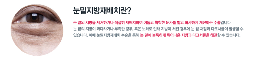 눈밑지방재배치에 대해 알아보자 관련 이미지 2