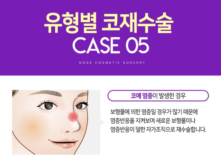 코재수술, 성공하기 위해서 알아야하는 체크사항 관련 이미지 13