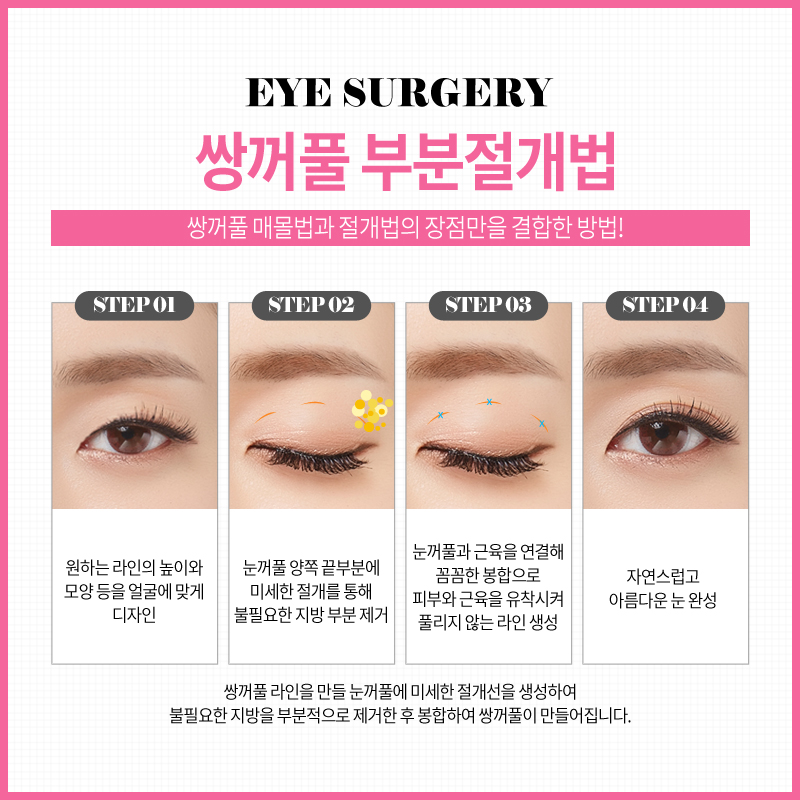 쌍꺼풀수술? 트임수술? 나에게 맞는 눈성형은? 관련 이미지 9
