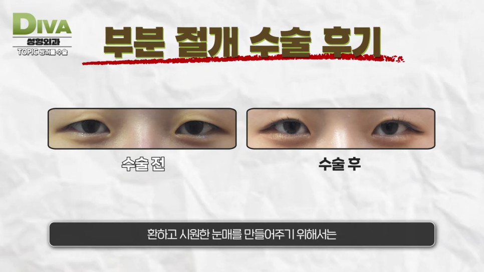 눈두덩이지방제거 깔끔한 라인으로 관련 이미지 6