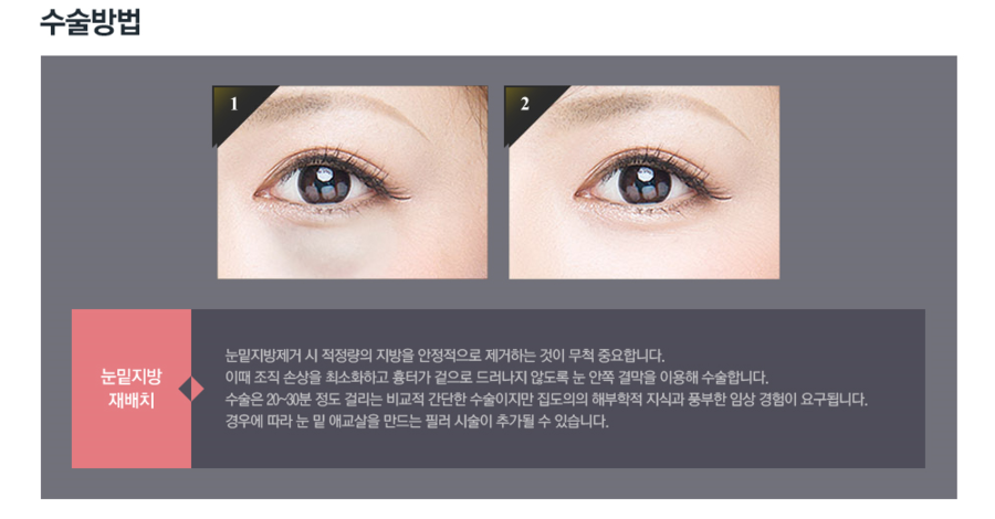 눈밑지방재배치에 대해 알아보자 관련 이미지 5