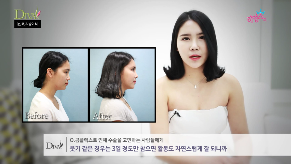 비절개눈매교정 자연스러운 라인으로 관련 이미지 5