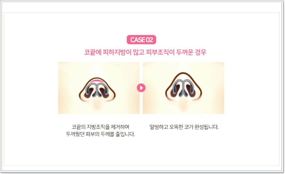 복코성형외과 진짜가 나타났다! 관련 이미지 5
