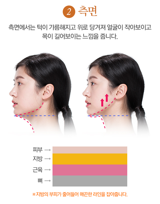 이중턱제거 한방에 해결! 관련 이미지 3