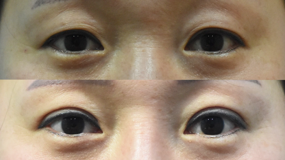 중년쌍꺼풀 자연스러운 눈매를 만들기 위해 관련 이미지 3