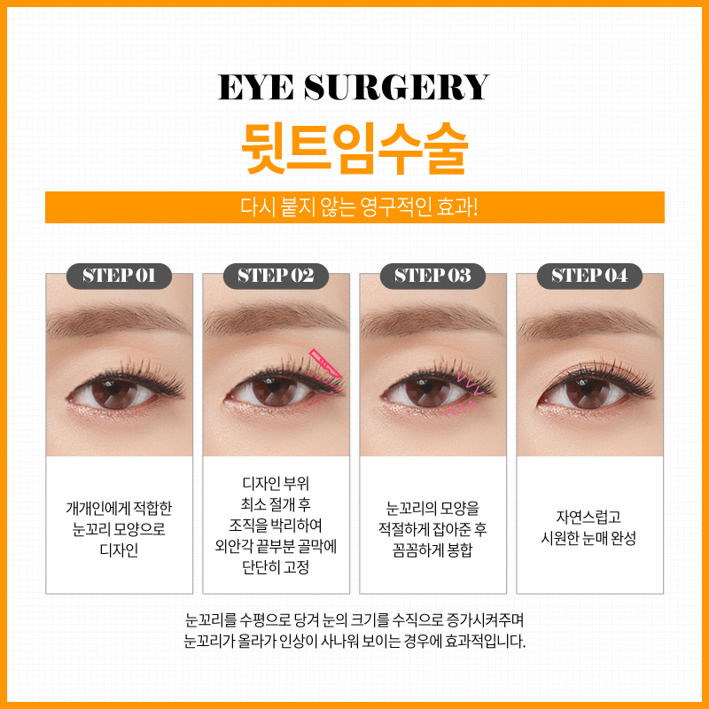 쌍꺼풀수술? 트임수술? 나에게 맞는 눈성형은? 관련 이미지 16