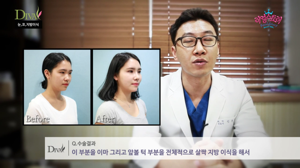 안검하수눈매교정 눈 처짐을 개선하면 관련 이미지 3