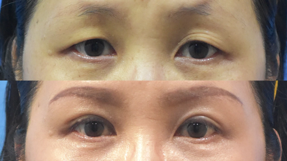 중년눈성형 깔끔한 확인으로 관련 이미지 4