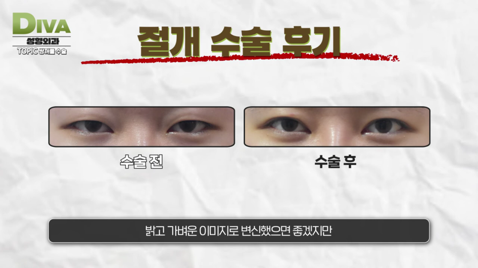 쌍꺼풀수술 맞춤 방법을 찾아서 관련 이미지 7